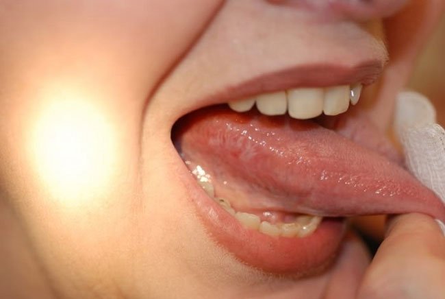 Что делать, если болит кончик языка?