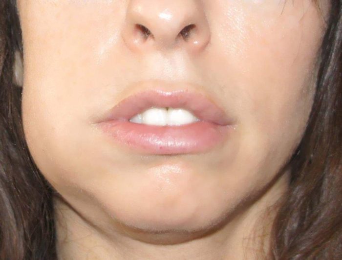 Альвеолит после удаления зуба симптомы фото