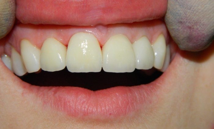 Что представляют собой керамические зубы?