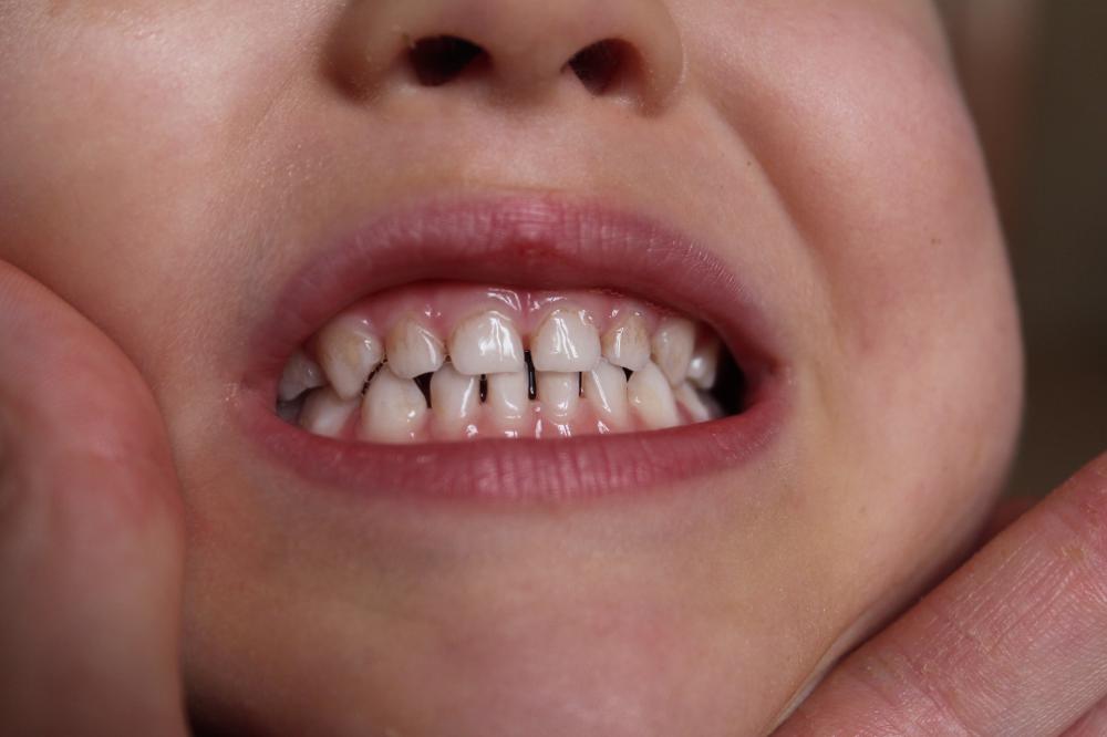Крошатся зубы у ребенка