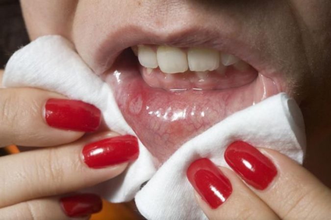 Способы лечения губного стоматита