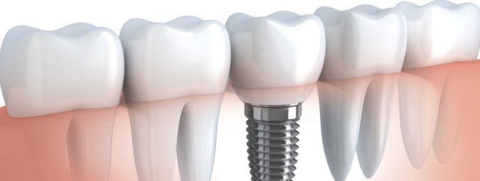 Какие противопоказания для установки зубных имплантов?