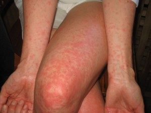 5 бесполезных действий при борьбе с аллергией на коже