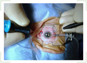 Операция при отслоение сетчатки глаза