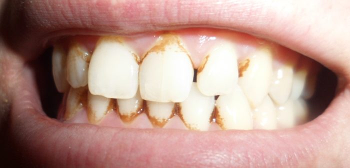 Коричневый налет на зубах