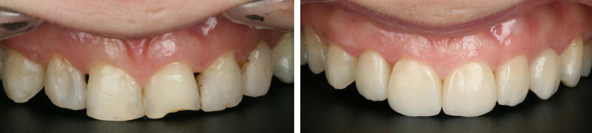 Микропротезирование зубов