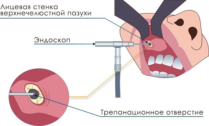 Как проводится эндоскопическая гайморотомия