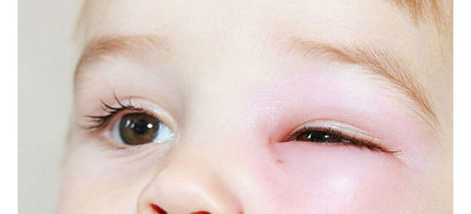 Опух глаз у ребенка