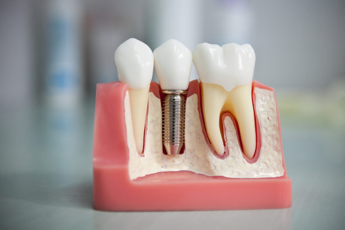 Какие противопоказания для установки зубных имплантов?
