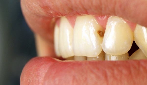 Что делать, если появился кариес на передних зубах?