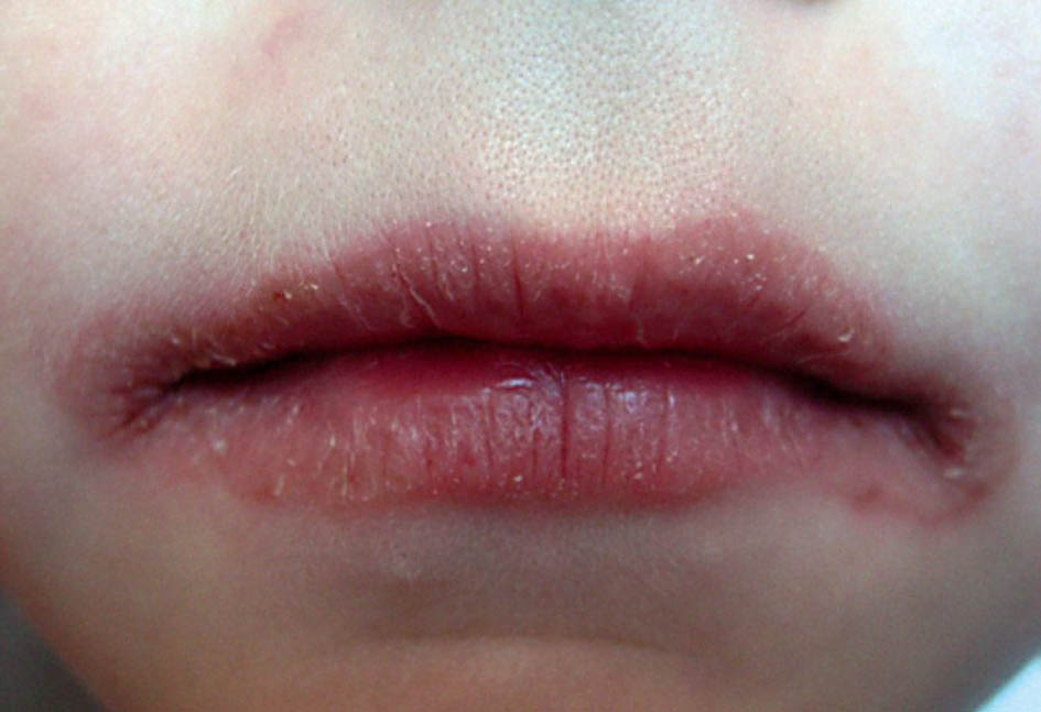 Как лечить хейлит на губах