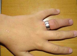 как снять кольцо с отекшего пальца