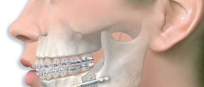 Остеотомия нижней челюсти