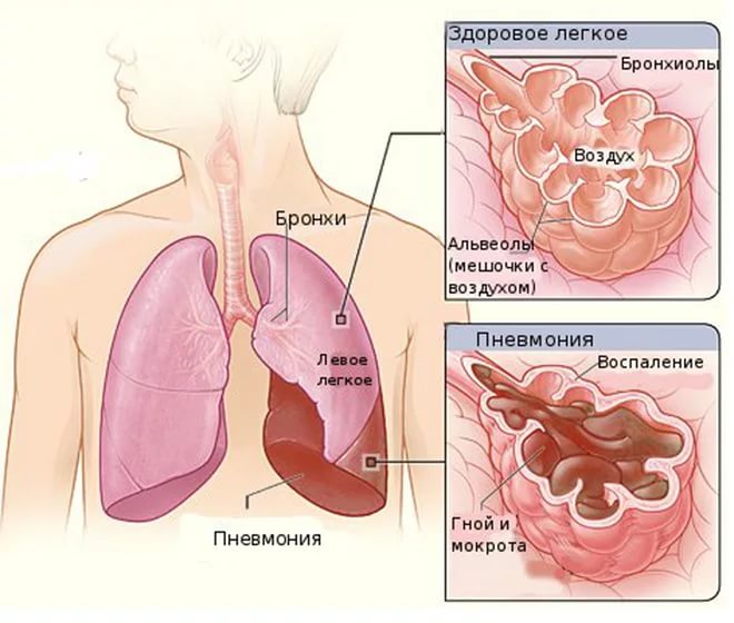 признаки пневмонии