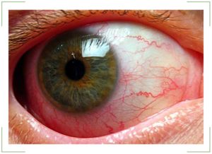 Болит глаз при моргании