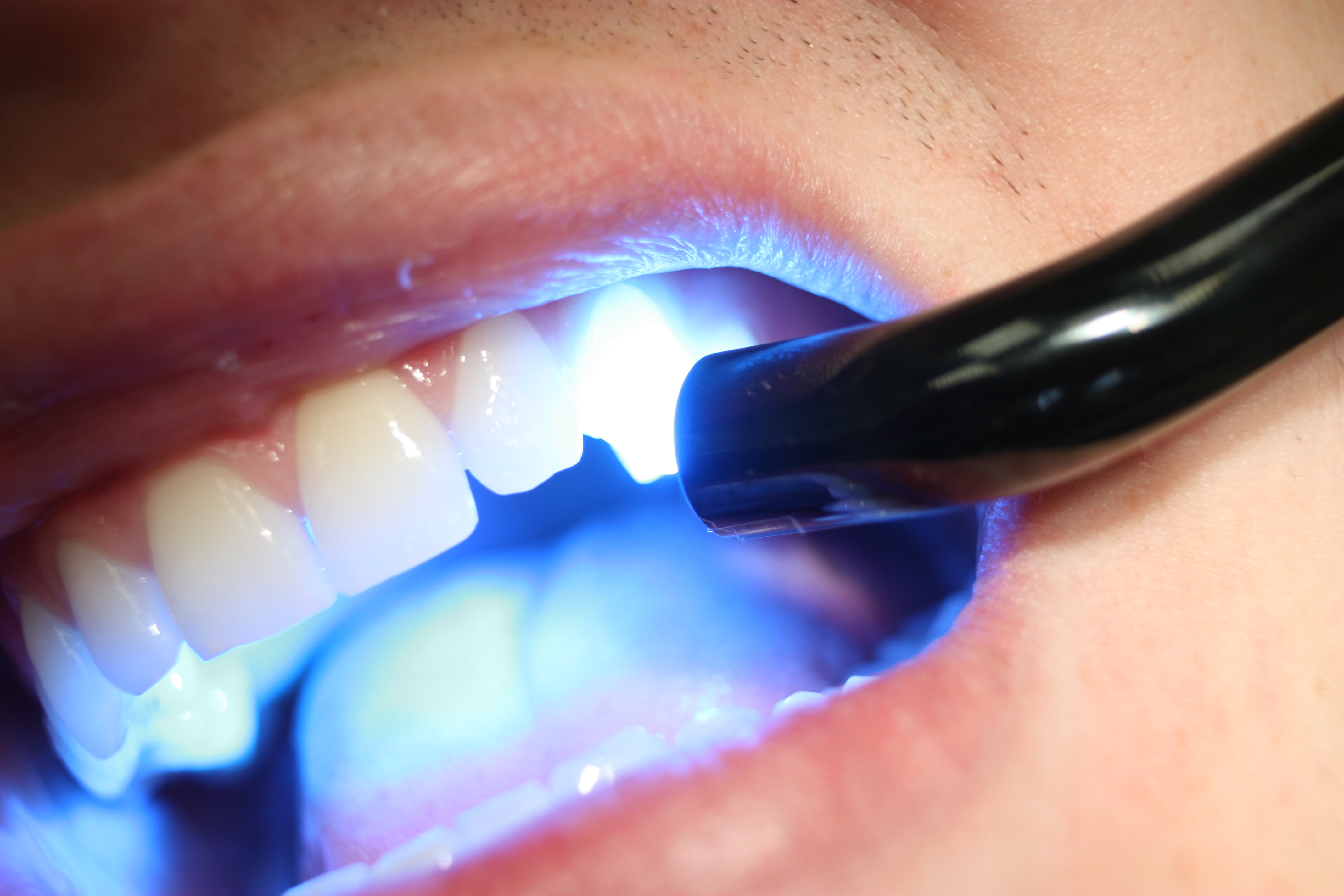 отбеливание зубов пломбы