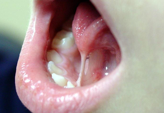 Для чего делается подрезание уздечки под языком у детей?