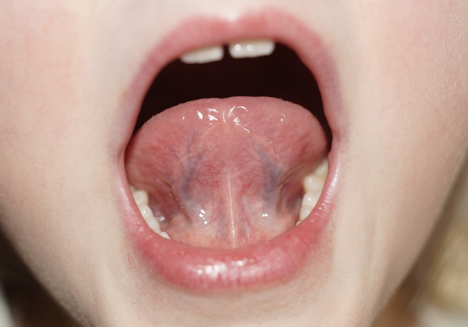 Причины появления шишки под языком