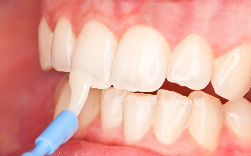 Дефект зуба клиновидный