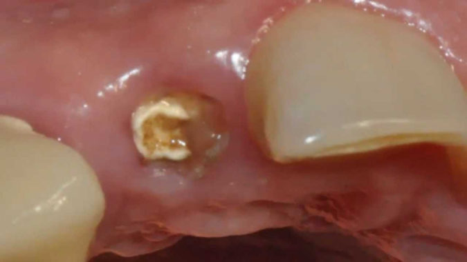Что можно сделать, если после удаления зуба остался осколок?