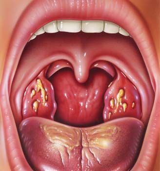 Миндалины в горле, воспаление, фото