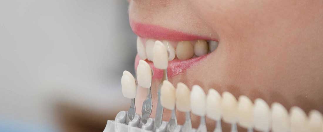 Как выполняется установка виниров на зубы?