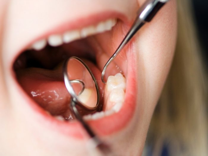 Что делать, если запломбировали зуб, а он болит при жевании?