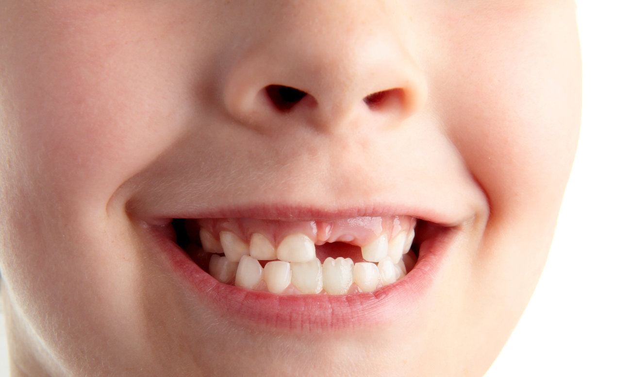 Как растут зубы у детей после выпадения молочных зубов фото до и после