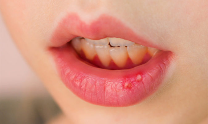 Способы лечения губного стоматита