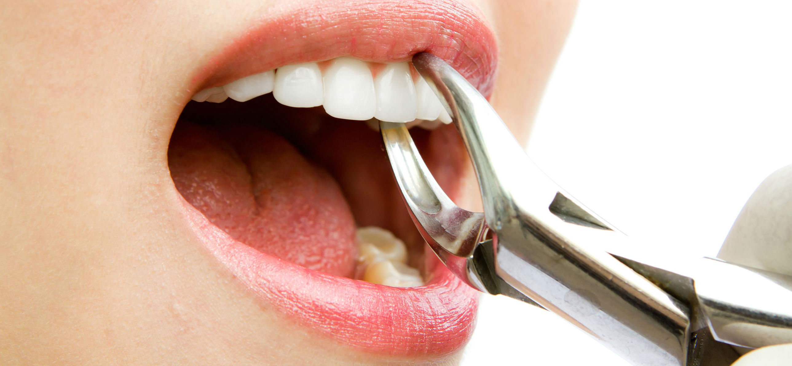 Сколько зубов можно удалить за один раз