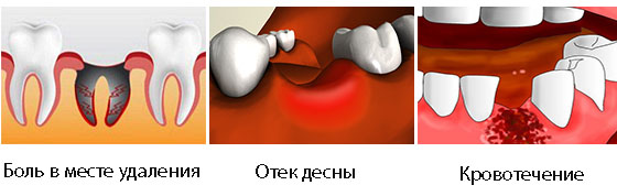 Заживление десны после удаления зуба фото