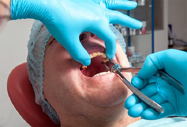 удаление зуба