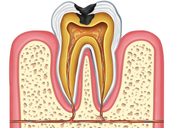 Болит зуб с мышьяком