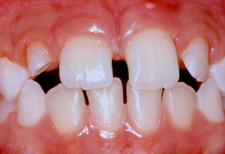Аномалия зубов