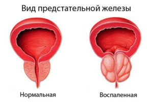 Норма и патология в размерах предстательной железы