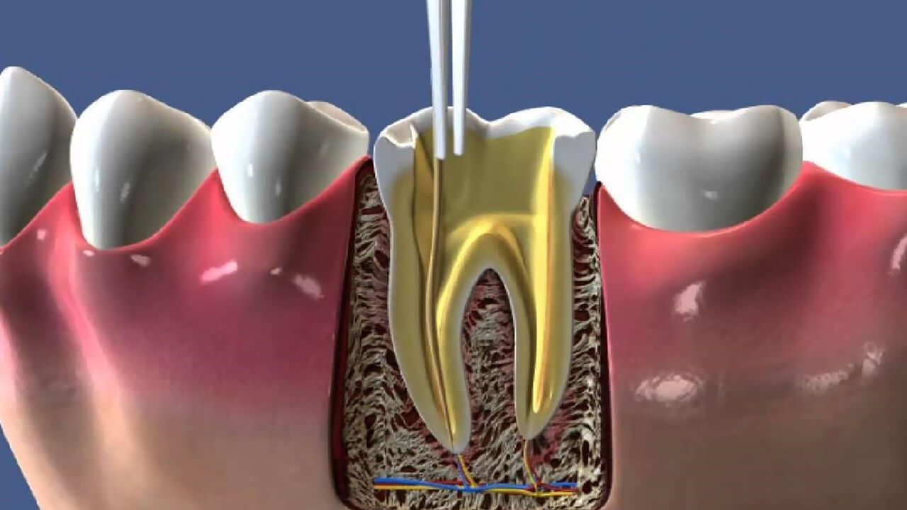 Зуб реагирует на горячее после удаления нерва
