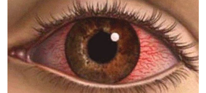 Ожог глаза