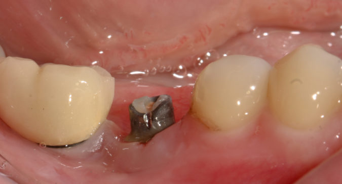 Почему происходит отторжение импланта зуба?