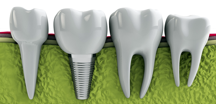 Как происходит имплантация зубов?