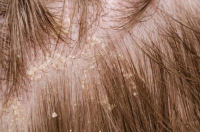 Болезни волосистой части головы какие можно лечить самому, а какие только под наблюдением врача