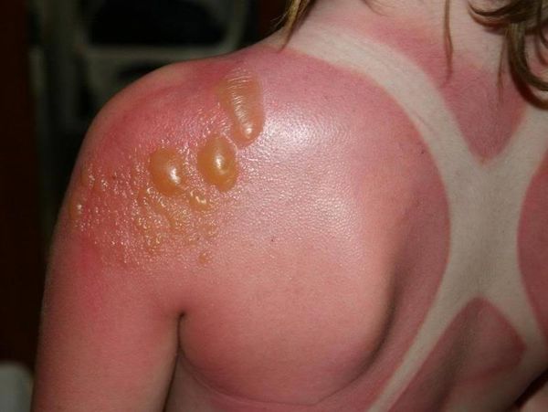 Уменьшаем негативное влияние солнца на кожу ищем эффективную альтернативу магазинным средствам
