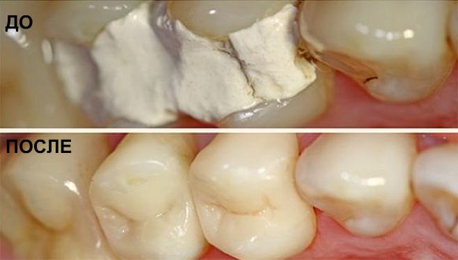 Мешает зуб после лечения thumbnail