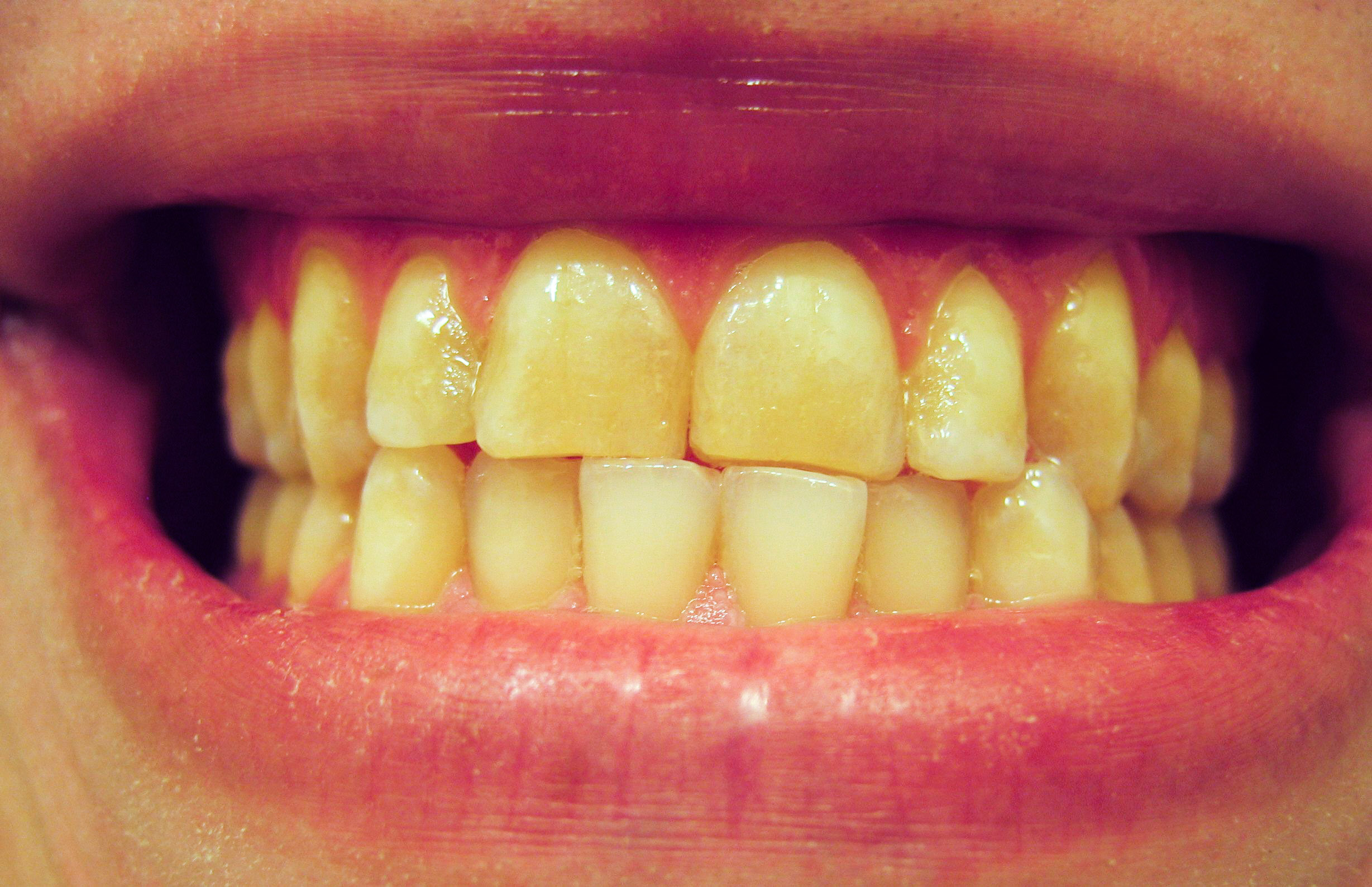 фото гниющих зубов