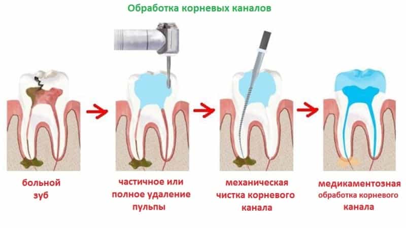 зубные каналы