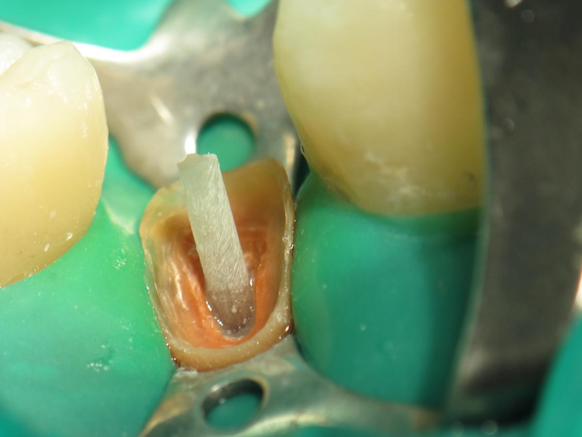 фото заживающей лунки зуба