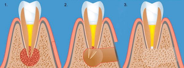 Как проводится лечение кисты челюсти?