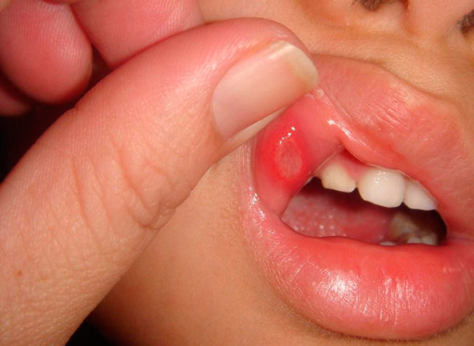 Чем вылечить язвы во рту (афтозный стоматит)?