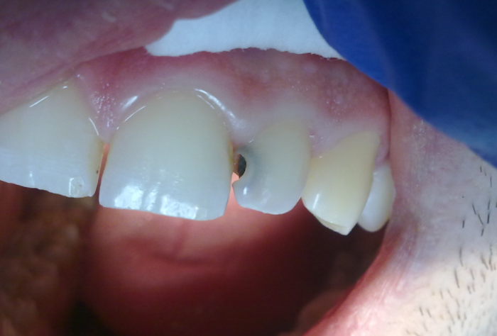 Почему почернел зуб под пломбой