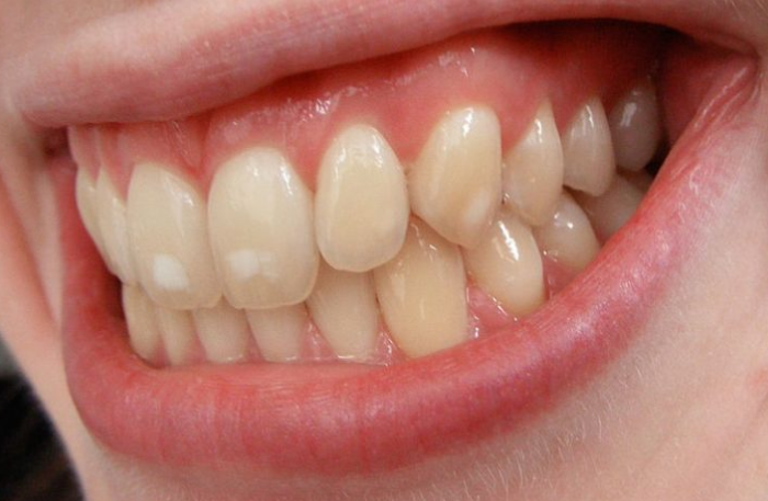 Что такое эрозия эмали зубов?