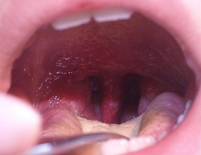 В каких случаях после удаления или лечения зуба может появиться стоматит?
